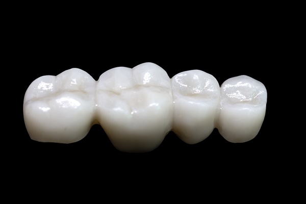 Dental Bridges Vs  Implants: Which Is The Better Tooth Replacement Option?